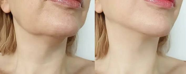 کرم لیفتینگ صورت و گردن لاکچری کوین